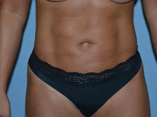 Liposuction--Case-Study-2950 | After Liposuction