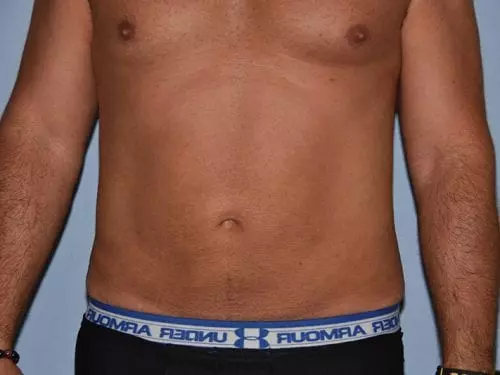 Liposuction--Case-Study-8416 | Before Body