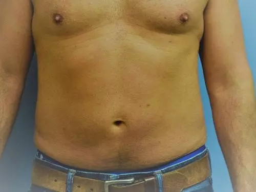 Liposuction--Case-Study-8416 | After Body