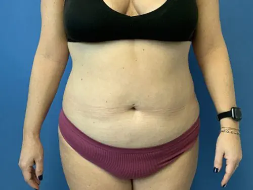 Liposuction--Case-Study-4826 | Before Body