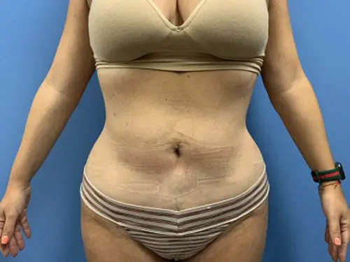 Liposuction--Case-Study-4826 | After Body
