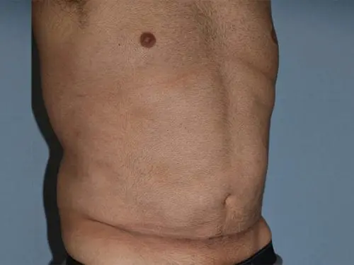 Liposuction--Case-Study-2953 | After Body