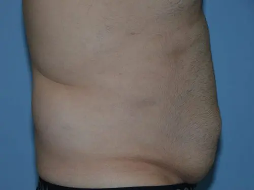 Liposuction--Case-Study-2953 | Before Body