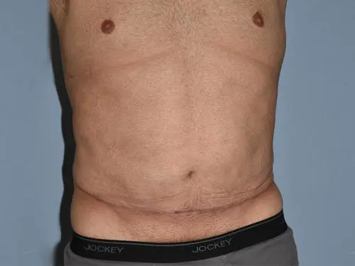Male-Tummy-Tuck--Case-3164 | After Male Tummy Tuck