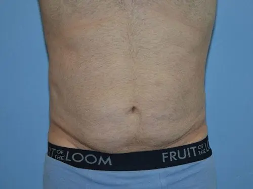 Male-Tummy-Tuck--Case-3164 | Before Male Tummy Tuck