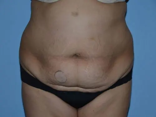 Tummy-Tuck-with-Liposuction--Case-Study-5108 | Before Liposuction