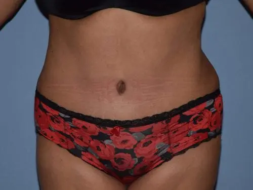 Tummy-Tuck-with-Liposuction--Case-Study-5108 | After Liposuction