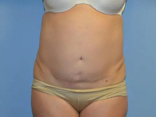 Tummy-Tuck--Case-Study-3068 | Before Body