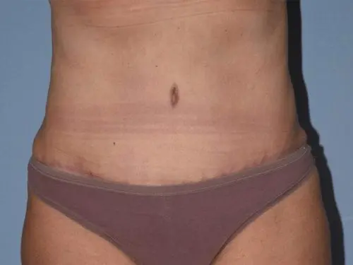 Tummy-Tuck-with-Liposuction--Case-Study-2860 | After Liposuction