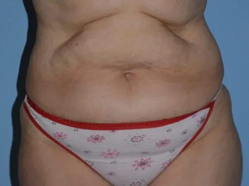 Tummy-Tuck-with-Liposuction--Case-Study-2860 | Before Liposuction