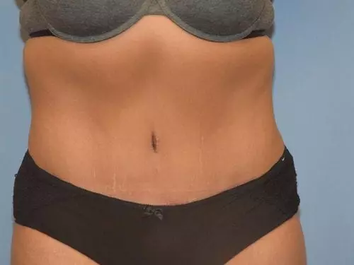 Tummy-Tuck--Case-Study-7284 | After Body