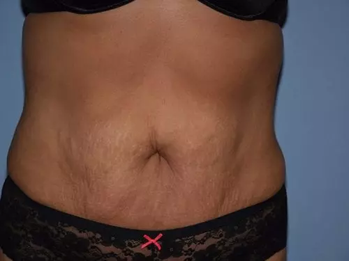 Tummy-Tuck--Case-Study-7284 | Before Body