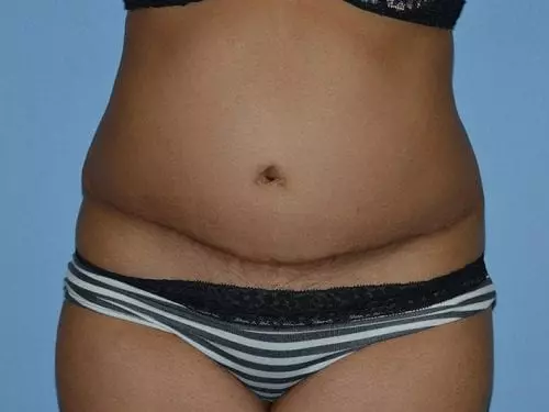 Tummy-Tuck-with-Liposuction--Case-Study-8162 | After Body