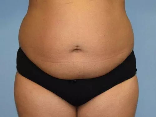 Tummy-Tuck-with-Liposuction--Case-Study-8162 | Before Body