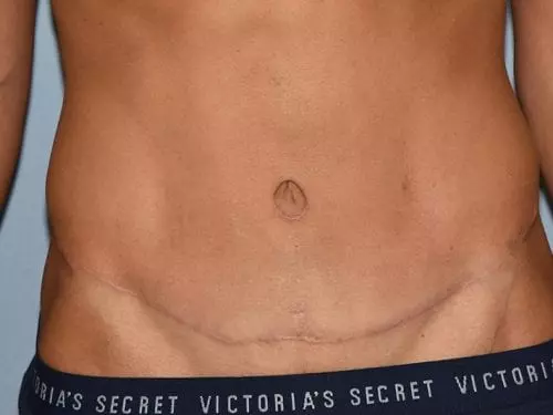 Tummy-Tuck-with-Liposuction--Case-Study-7351 | After Body