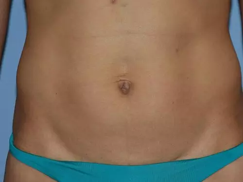 Tummy-Tuck-with-Liposuction--Case-Study-7351 | Before Body