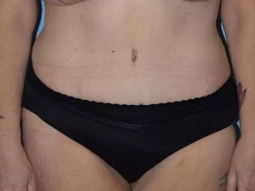 Tummy-Tuck--Case-Study-3085 | After Body
