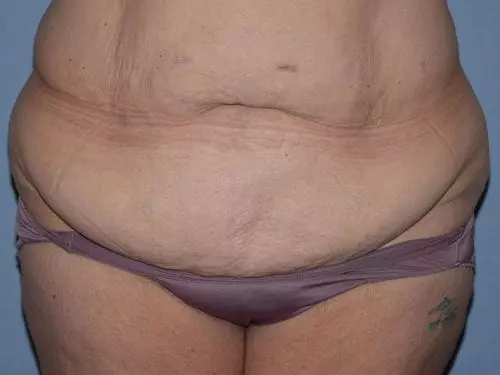 Tummy-Tuck--Case-Study-3085 | Before Body