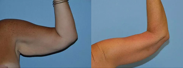 Arm Lift actual patient results 2