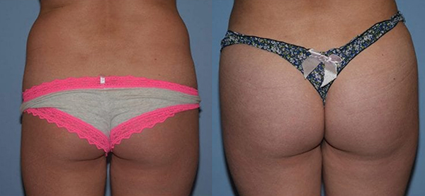 Before and after results of a brazilian butt lift patient