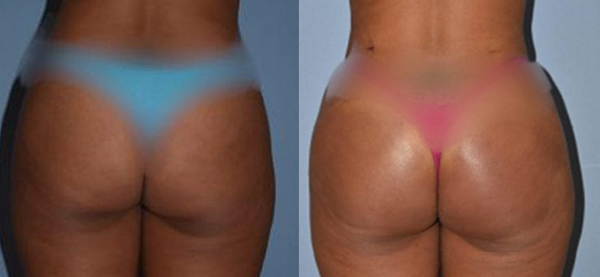 2nd patient before and after brazilian butt lift surgery