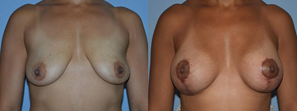 Breast Lift Patient 02 before and after