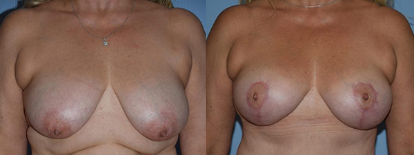 Breast Lift Patient 03 before and after