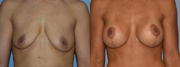 Breast Lift Patient 01 before and after