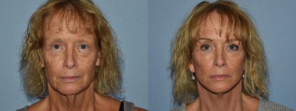 Facelift patient facing forward