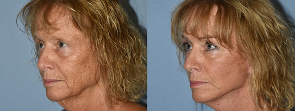 Facelift patient facing the left