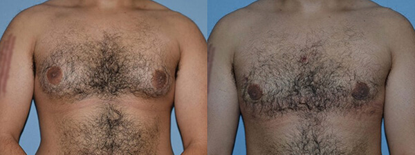 Gynecomastia actual patient results 1