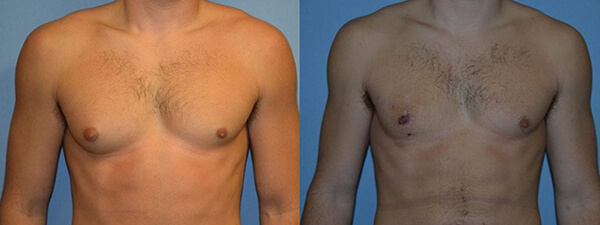 Gynecomastia actual patient results 2