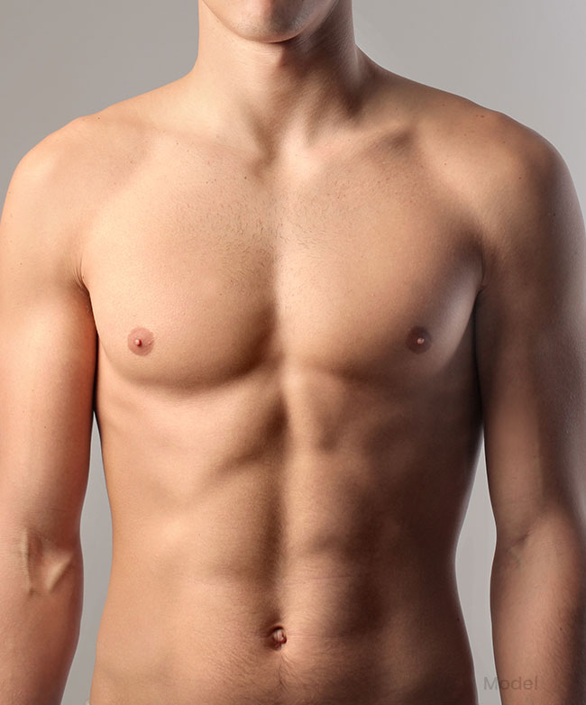 model gynecomastia