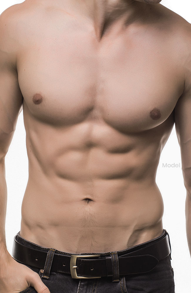 Gynecomastia model