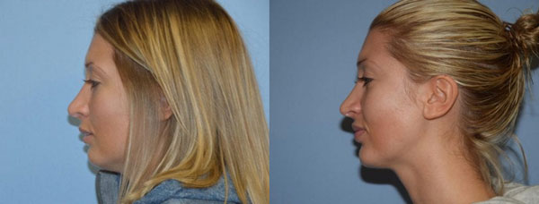 Rhinoplasty patient before and after