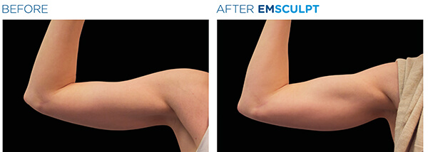 Emsculpt Actual Patient 1