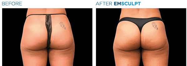 Emsculpt Actual Patient 2
