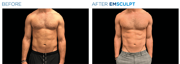 Emsculpt Actual Patient 3