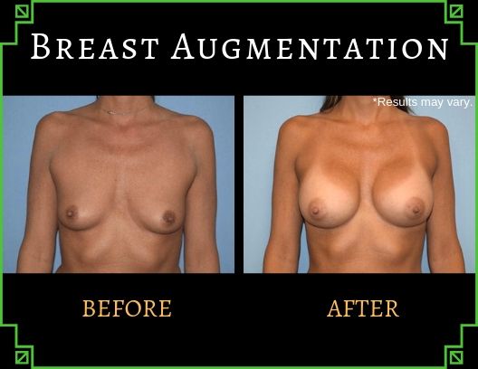 Woman in her late 40’s before and after breast augmentation