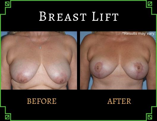 Woman in her 50's, mother of 2 after a mommy makeover which included a breast lift