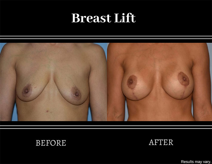 Before and after image of a woman after a breast lift procedure. Sagging and drooping were corrected.