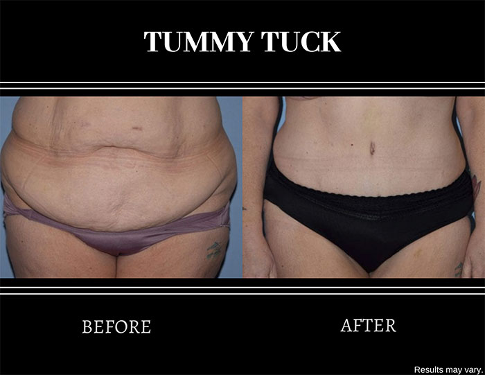 Before and after image of a woman after undergoing a tummy tuck procedure. Excess skin, tissue, and fat were all removed.