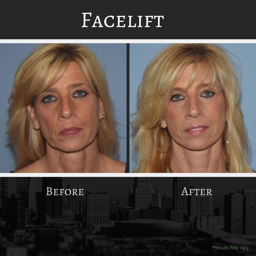 Before -and-after images of a facelift.