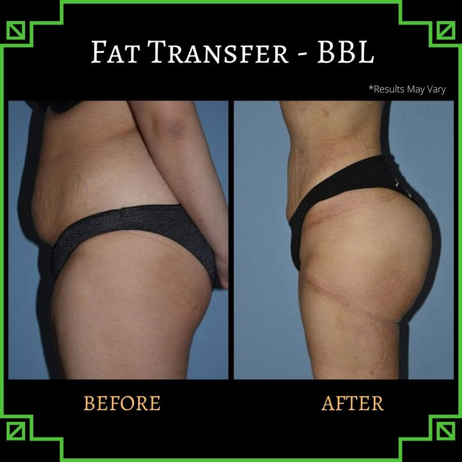 Fat transfer can get rid of fatty deposits on the lower belly and re-inject them into other areas for unmistakable enhancement, as shown in this before and after shot of a young woman who received a Brazilian Butt Lift.
