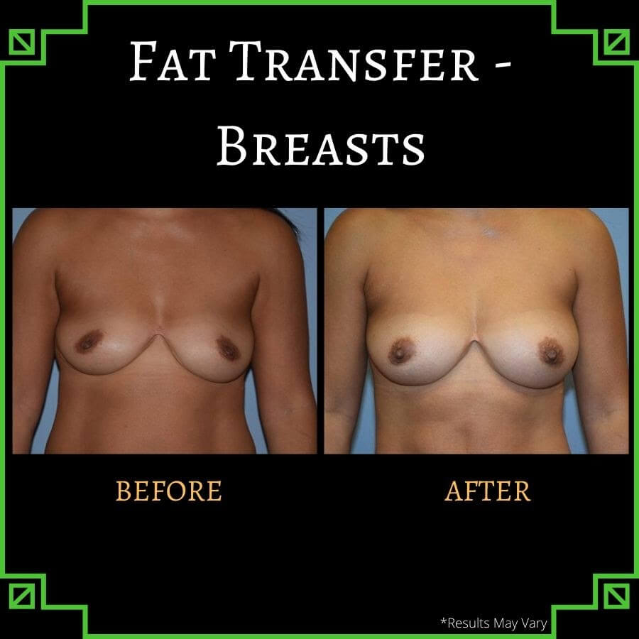 Fat transfer provides results that fit in beautifully with the rest of your body—all without the use of foreign substances or implants, as shown in this before-and-after shot of a young woman who received fat transfer for breast augmentation.