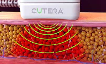 Radiofrequency Diagram