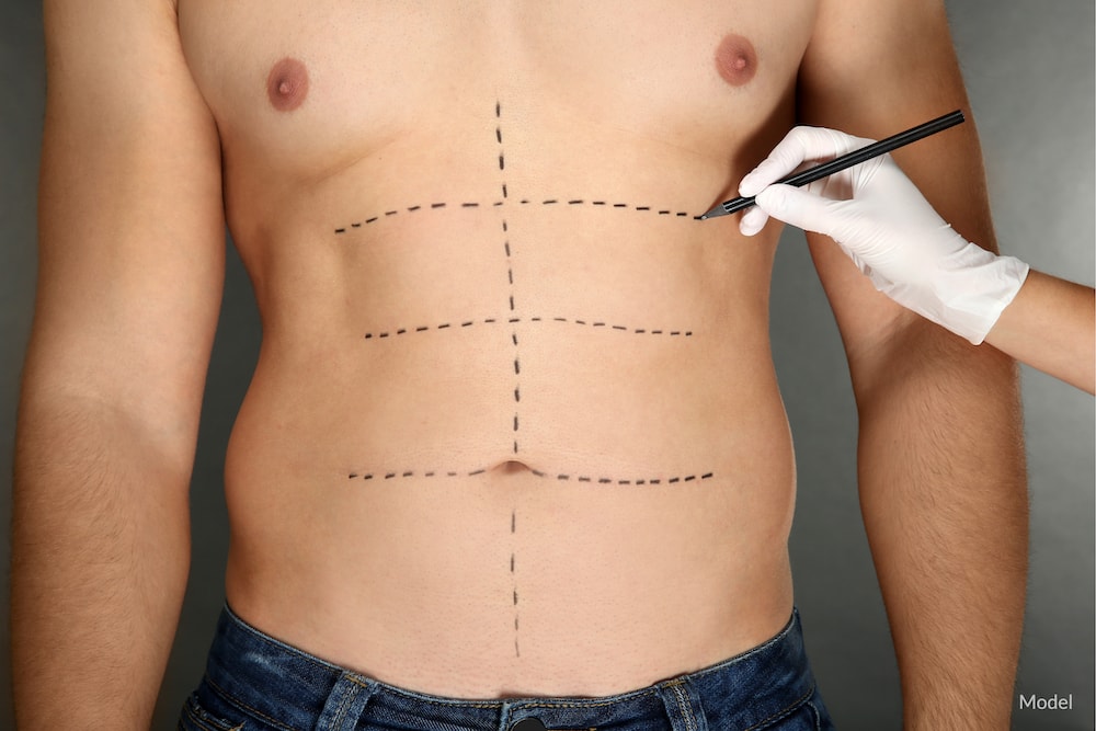 Man with plastic surgery treatment lines drawn on his abdomen.