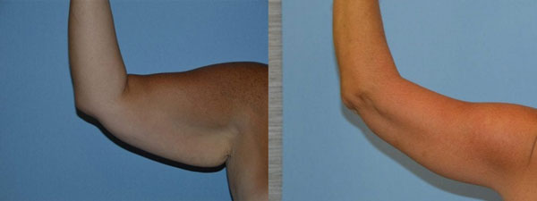 Arm Lift actual patient results