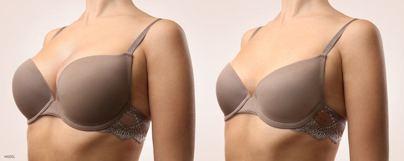 breast reduction concept art, before and after surgery