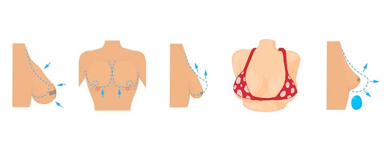 Illustration demonstrating difference breast deformities